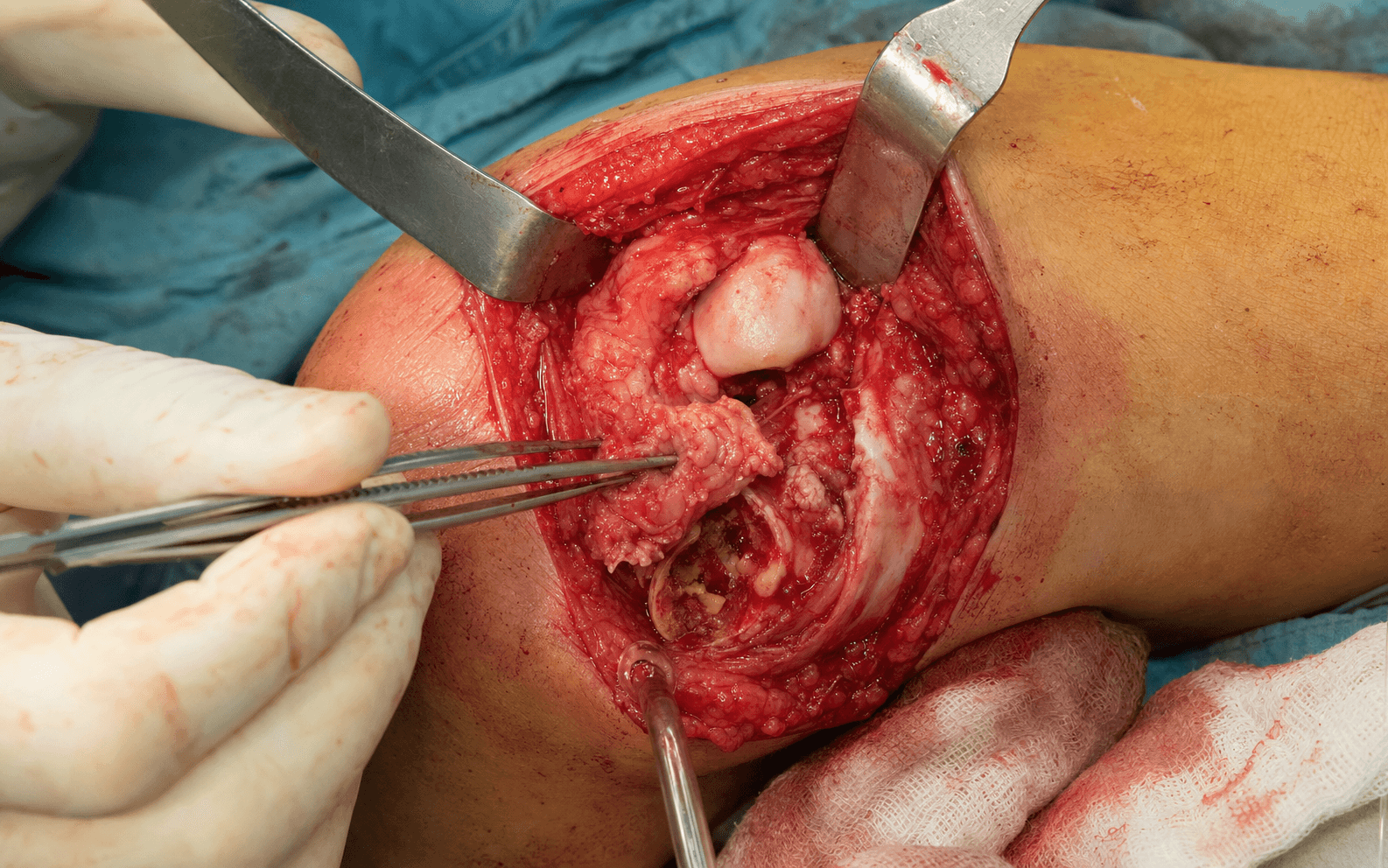 Rheumatoid elbow synovectomy
