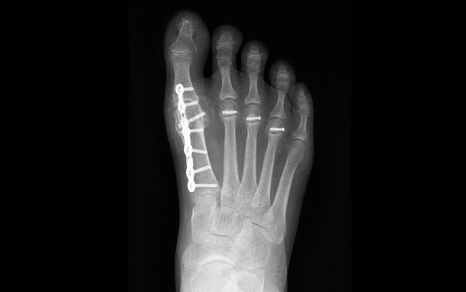 Rheumatoid forefoot reconstruction