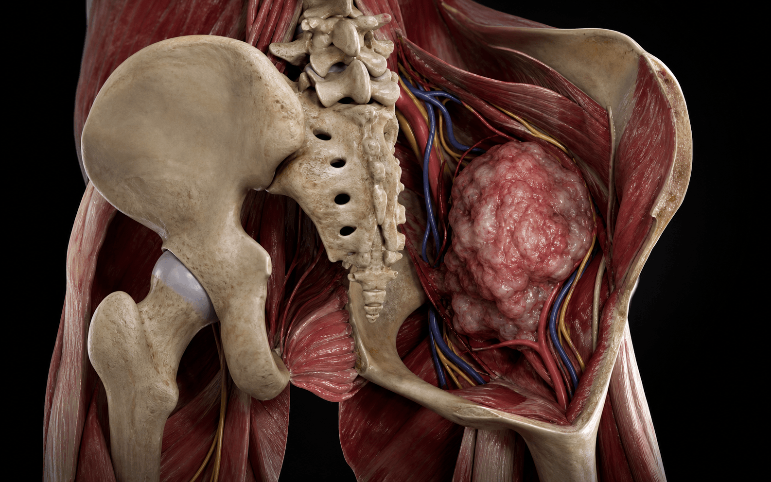 Sacral/pelvic tumour