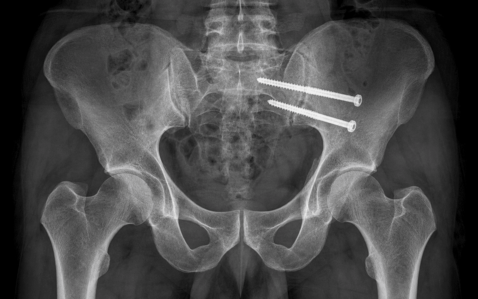 Iliosacral screw fixation