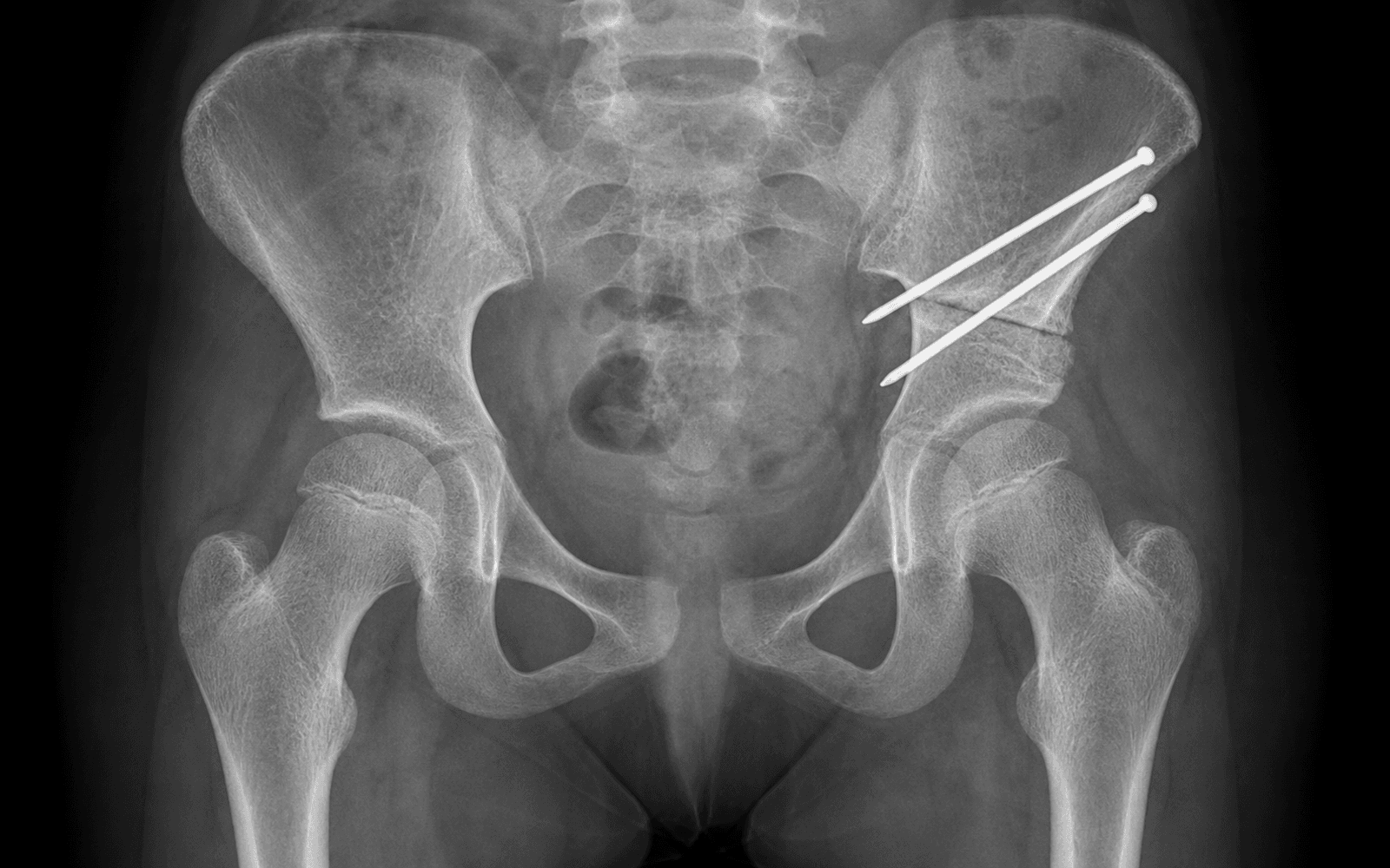Paediatric pelvic radiograph after a Salter innominate osteotomy