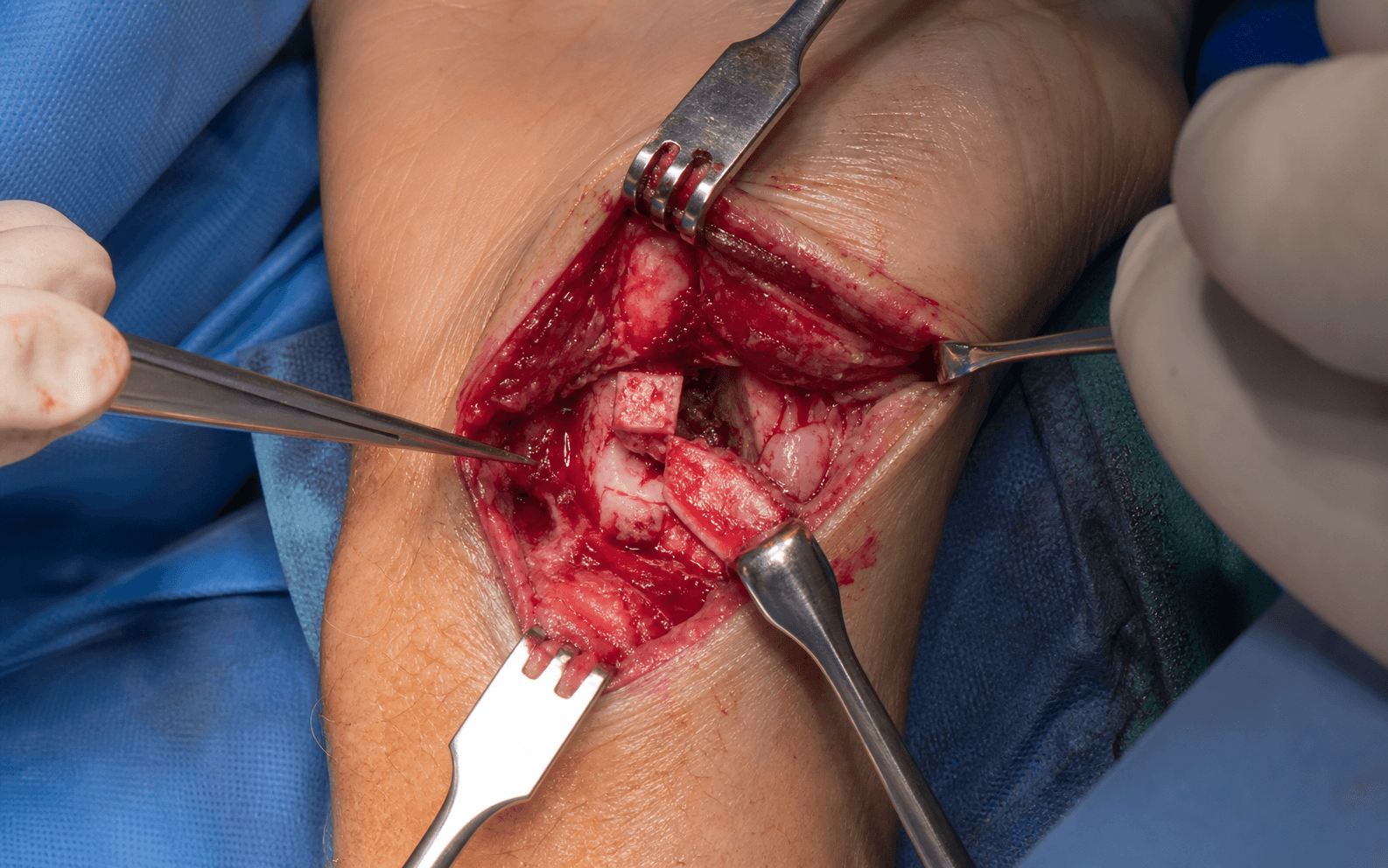 Scaphoid nonunion vascularised graft