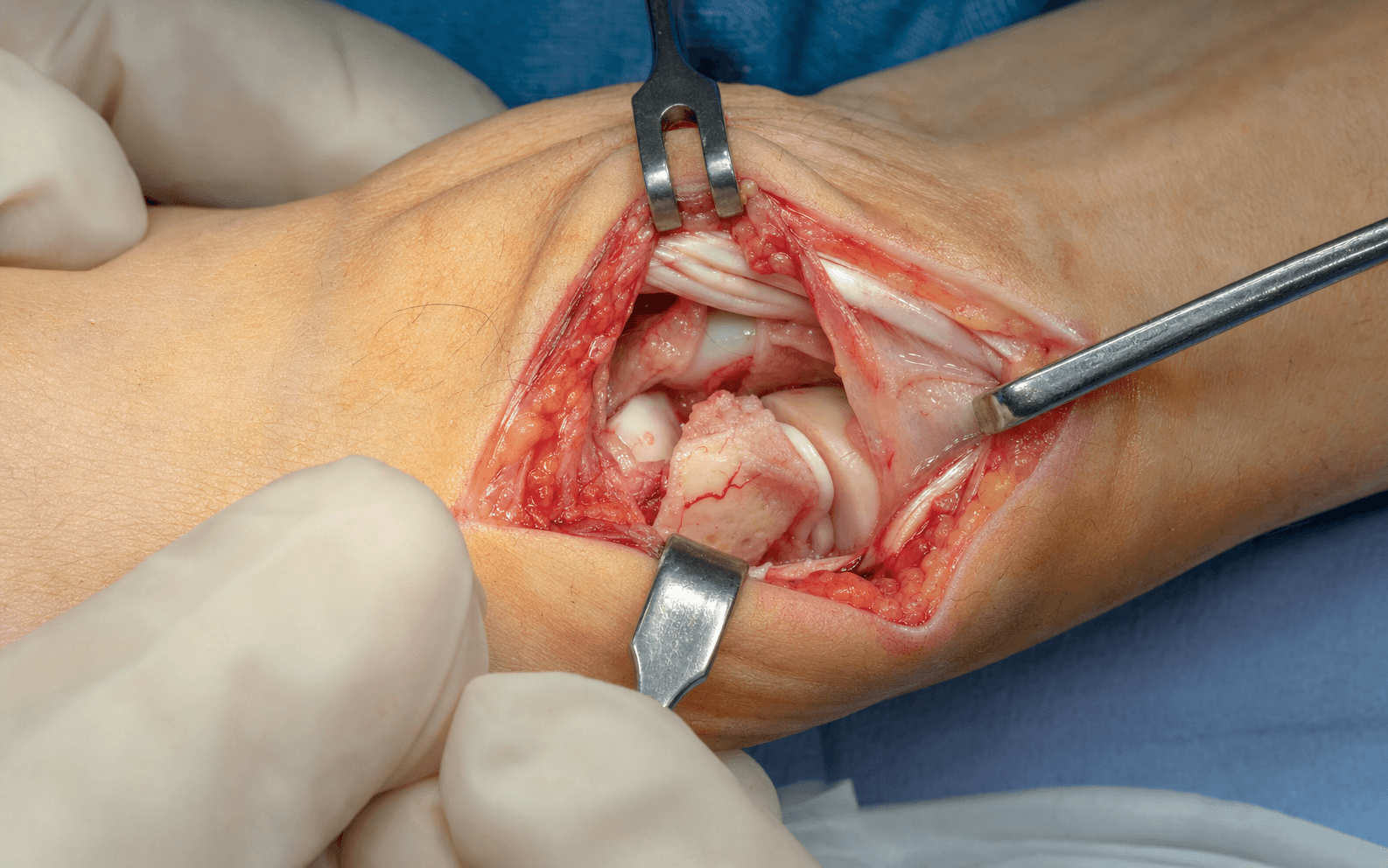 Scaphoid proximal pole ORIF