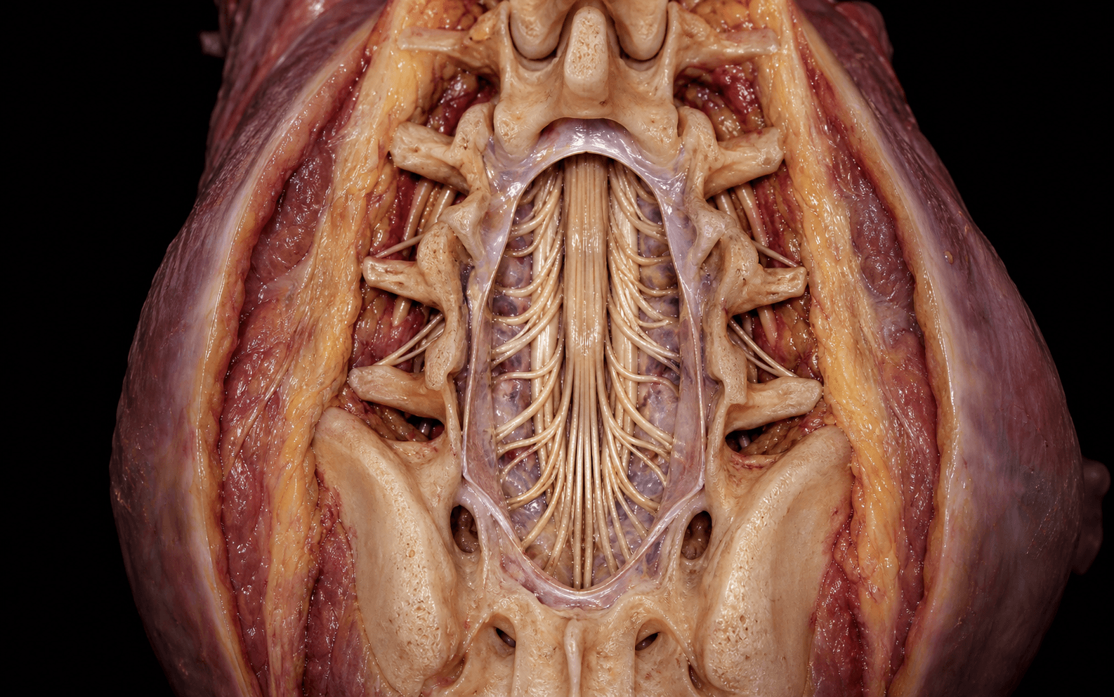 Selective dorsal rhizotomy