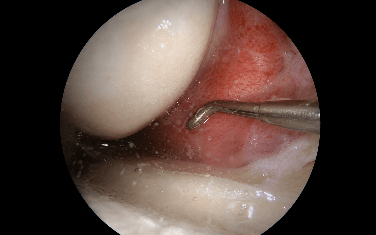 Arthroscopic septic washout