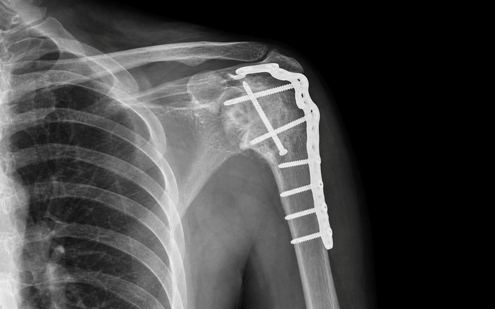 Shoulder arthrodesis