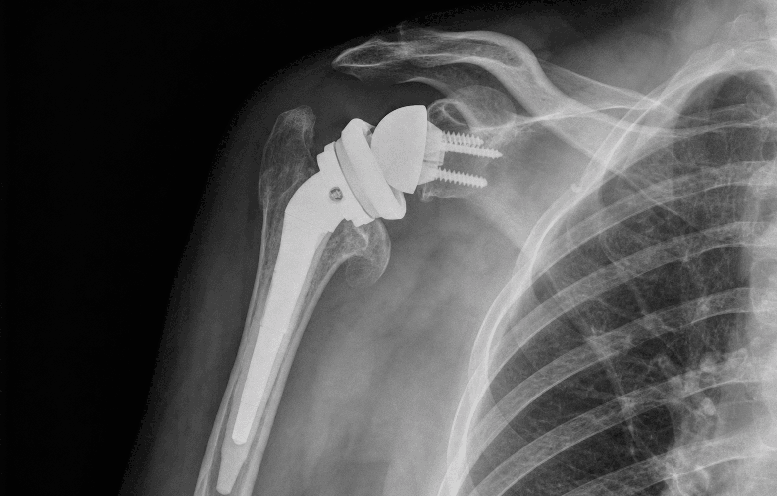 AP shoulder radiograph of a shoulder arthroplasty