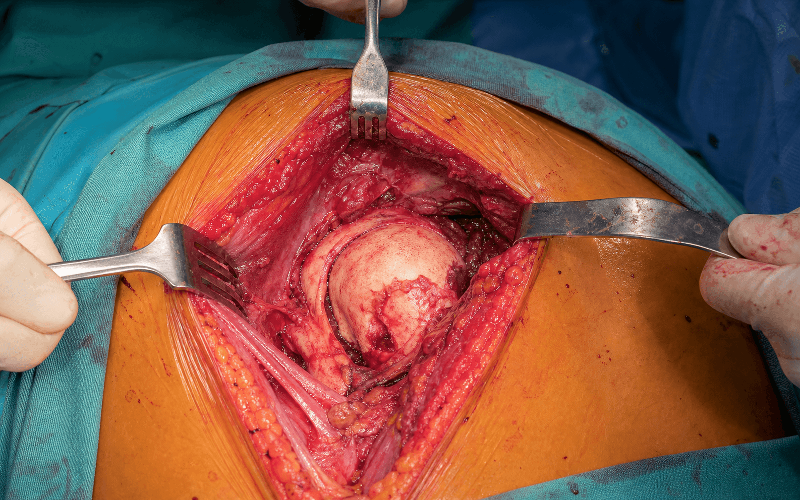 Shoulder hemiarthroplasty exposure