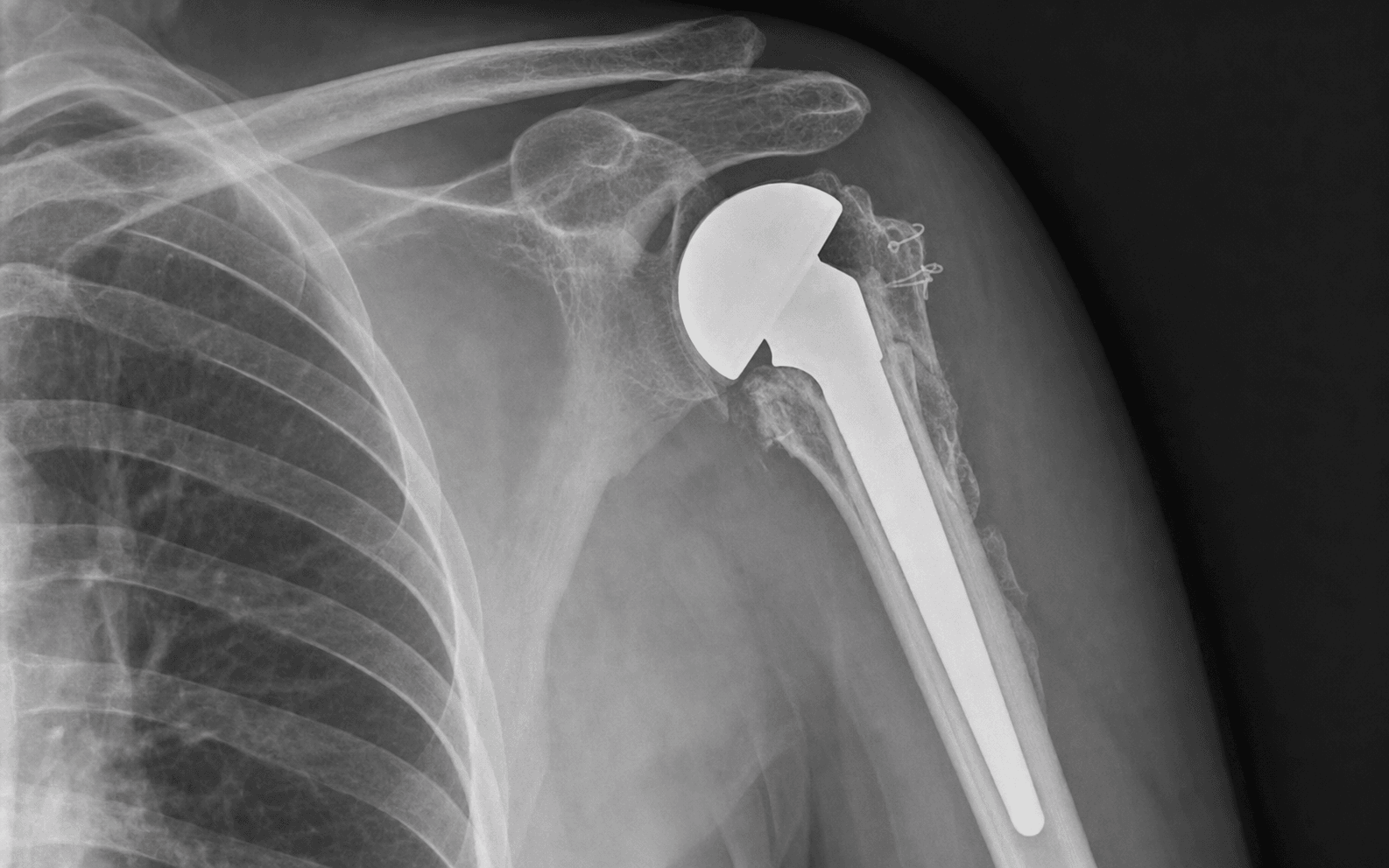 Hemiarthroplasty for fracture