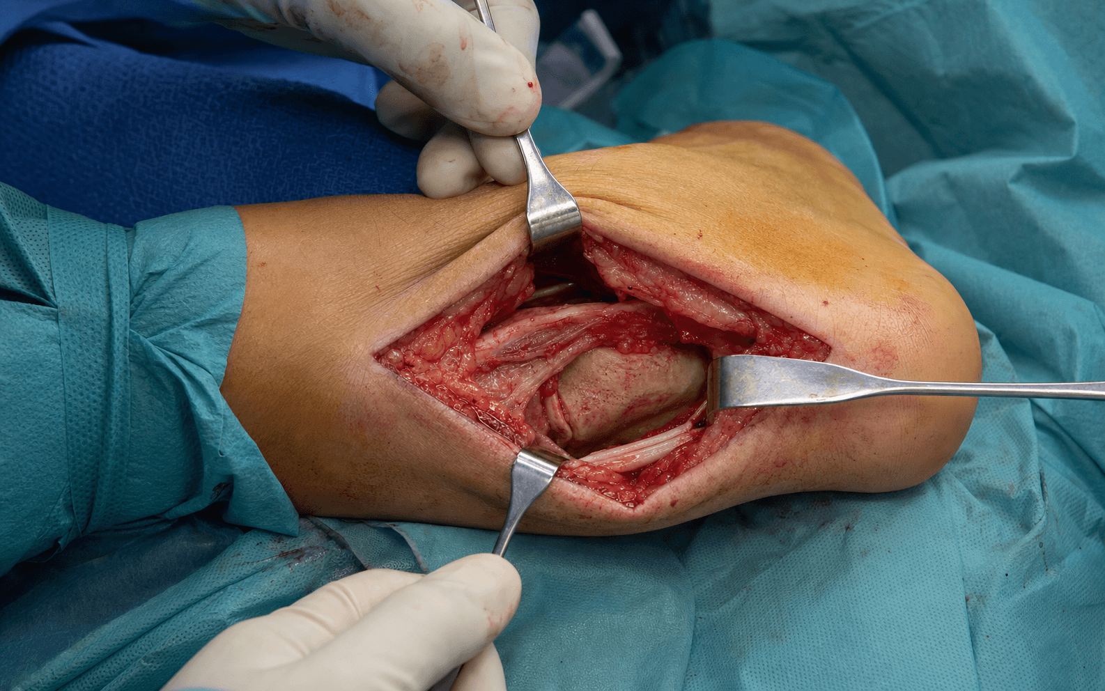 Sinus tarsi approach