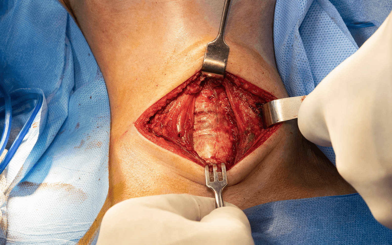 Smith-Robinson anterior cervical
