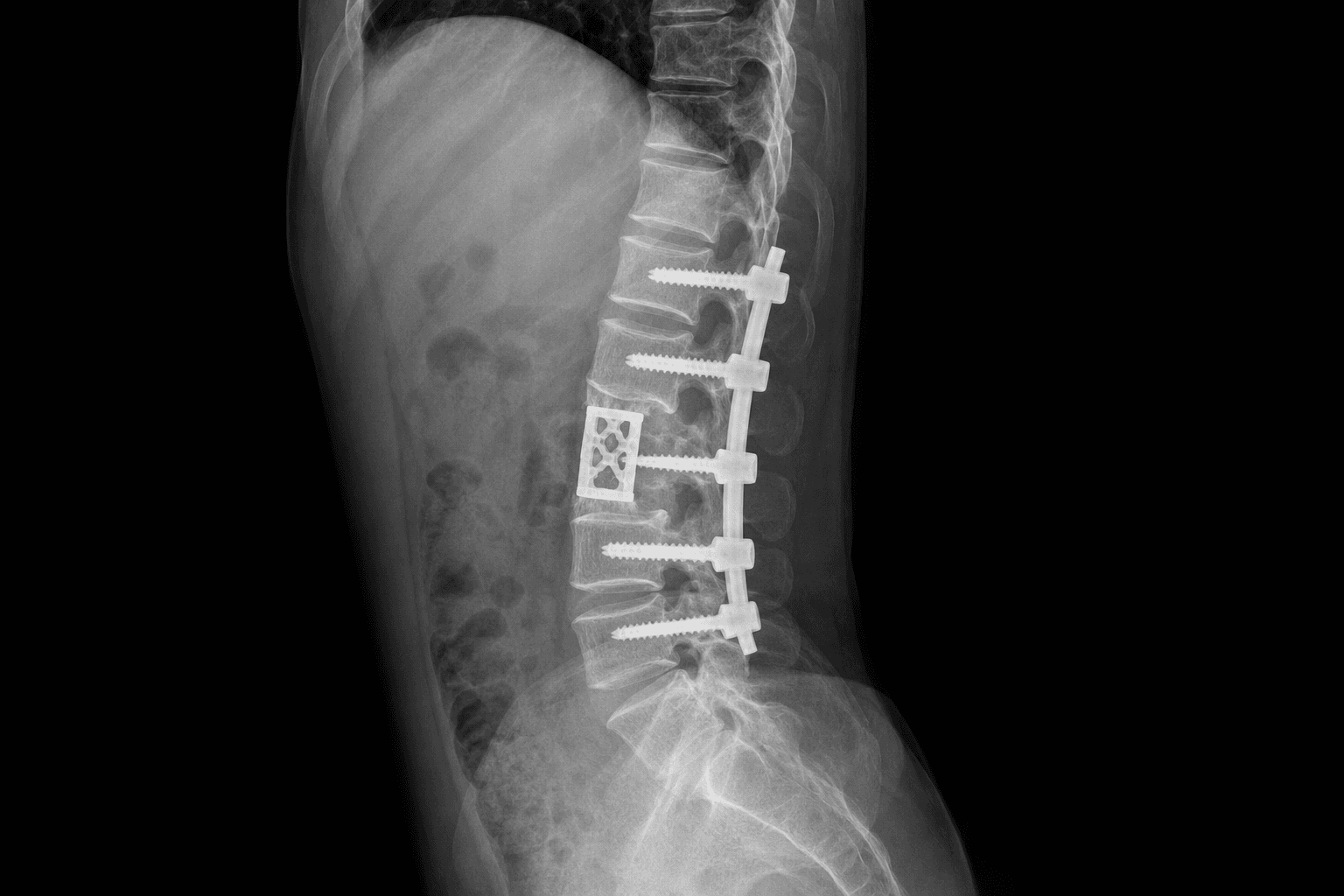Spinal TB debridement and instrumented fusion
