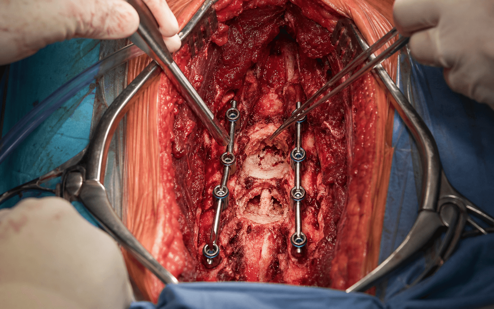 Spine tumour decompression