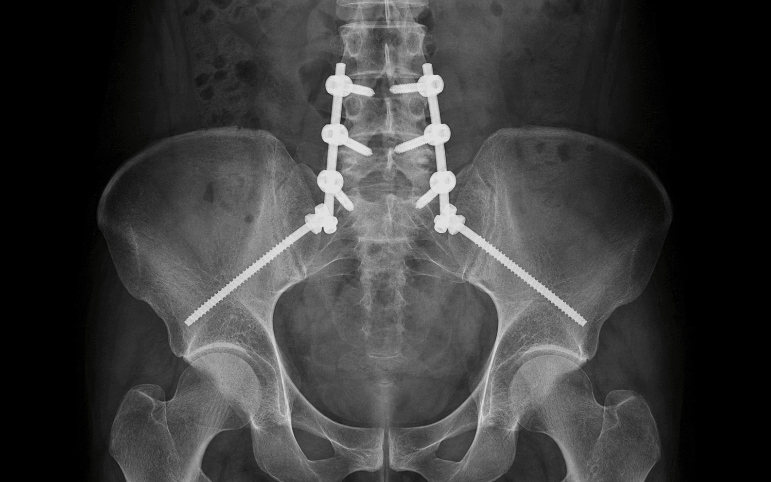 Lumbopelvic fixation