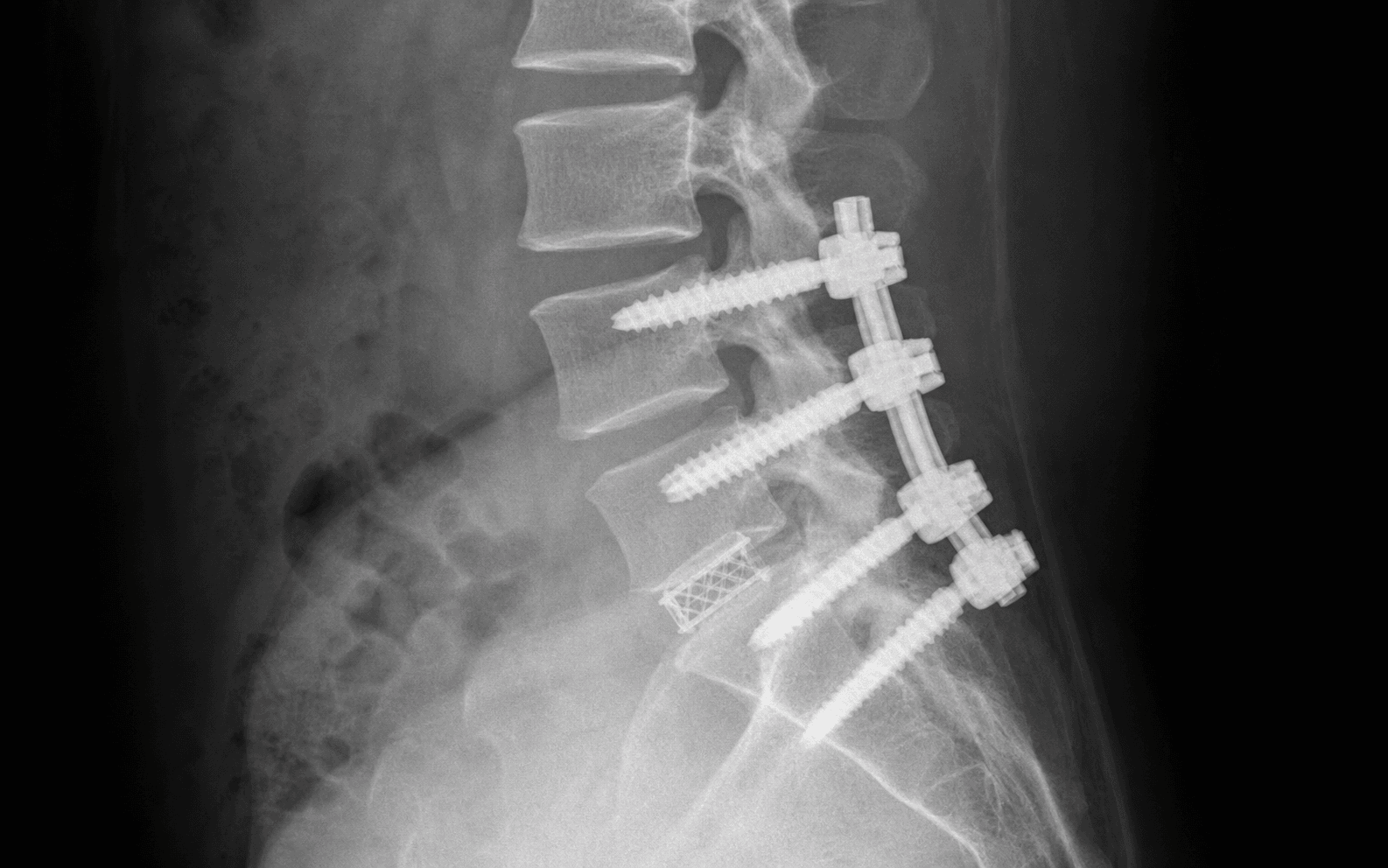 Spondylolisthesis reduction + fusion