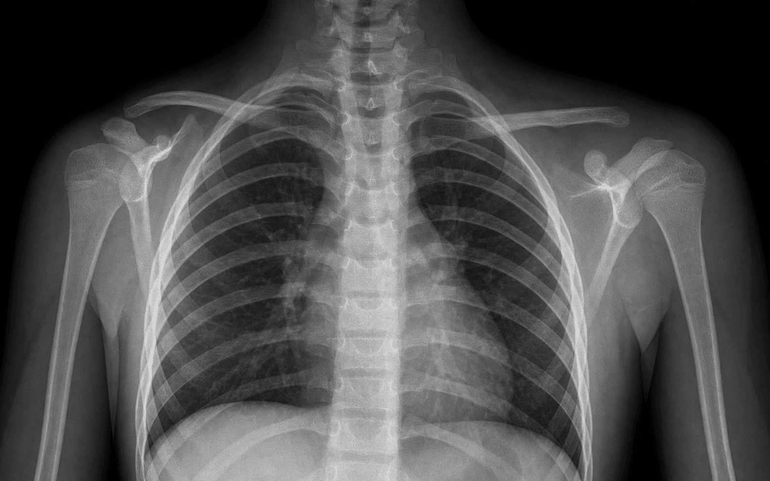 Sprengel high-riding scapula