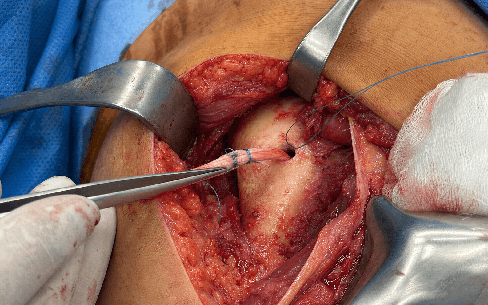 Subpectoral biceps tenodesis