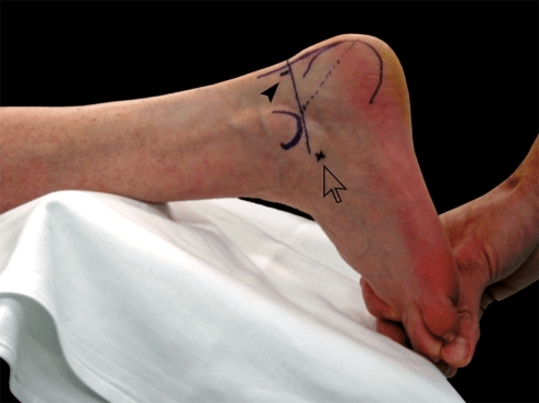 Lateral foot with portal markings drawn on skin for arthroscopic subtalar arthrodesis