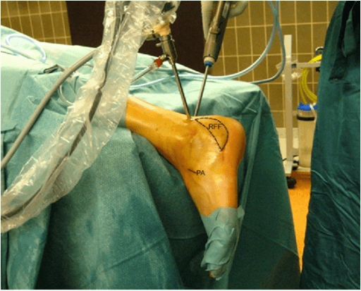 Intraoperative arthroscopic subtalar arthrodesis setup with foot draped