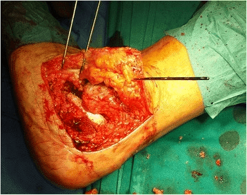 Open subtalar arthrodesis intraoperative view with probe showing posterior facet