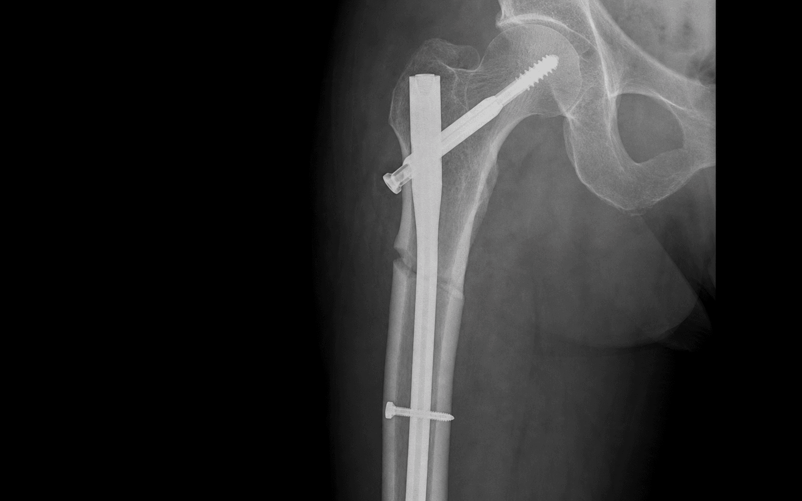 Subtrochanteric femur fracture fixed with a cephalomedullary nail