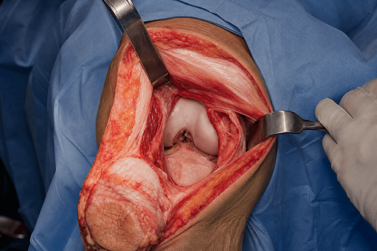 Subvastus approach to the knee