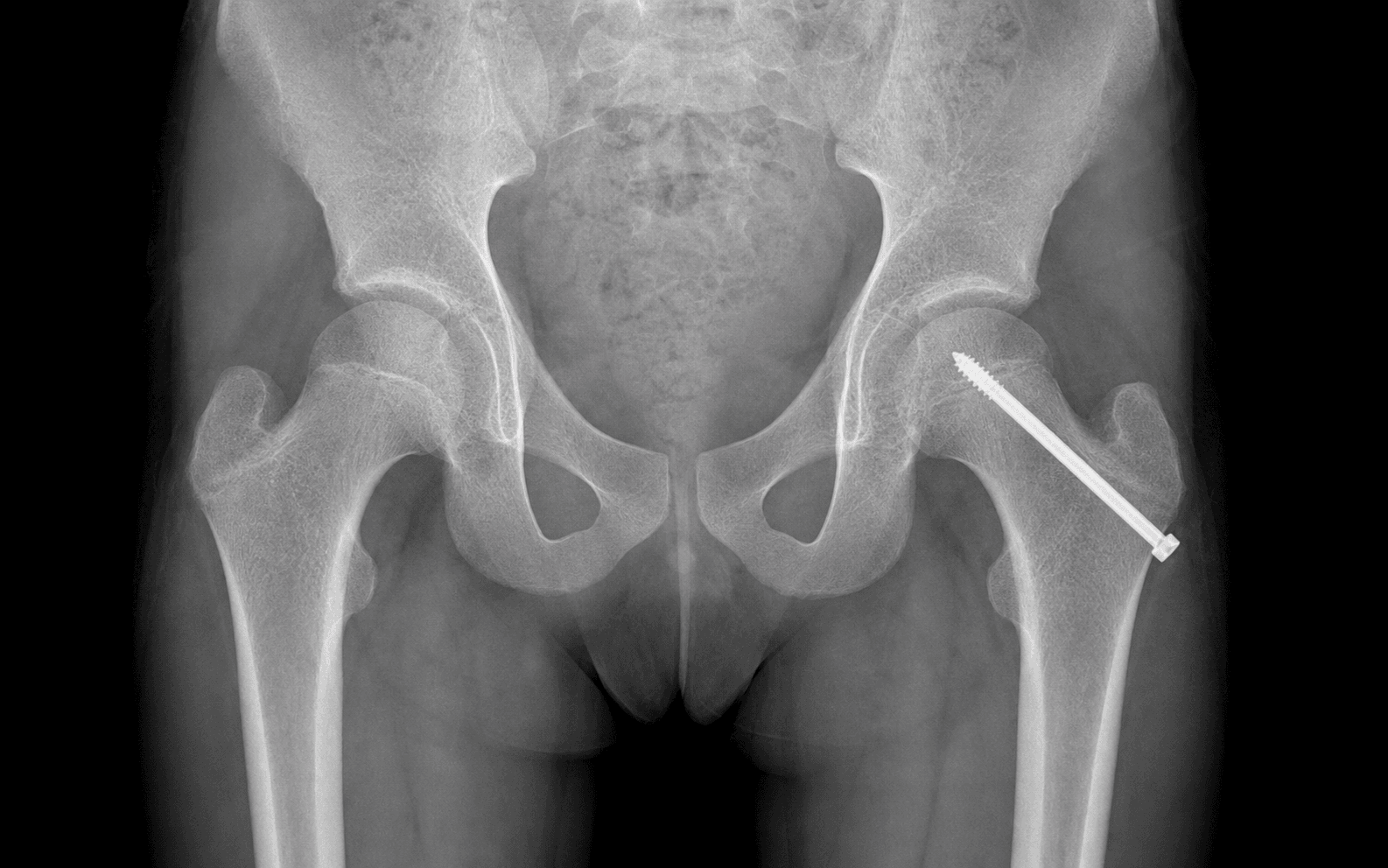 SUFE in-situ pinning
