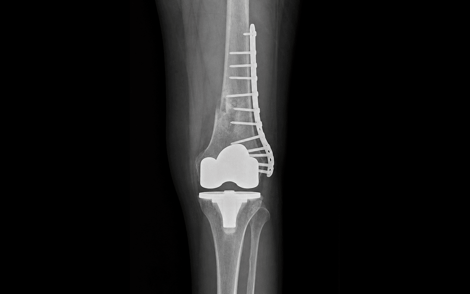 Periprosthetic supracondylar femur ORIF
