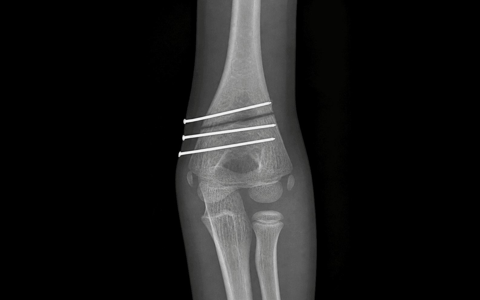 Cubitus varus osteotomy