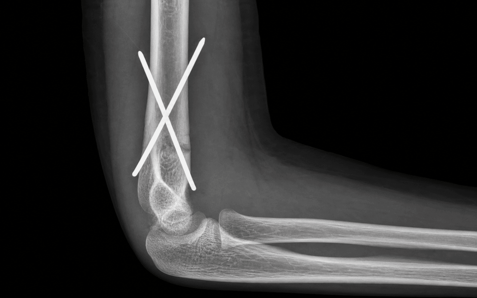 Supracondylar percutaneous pinning