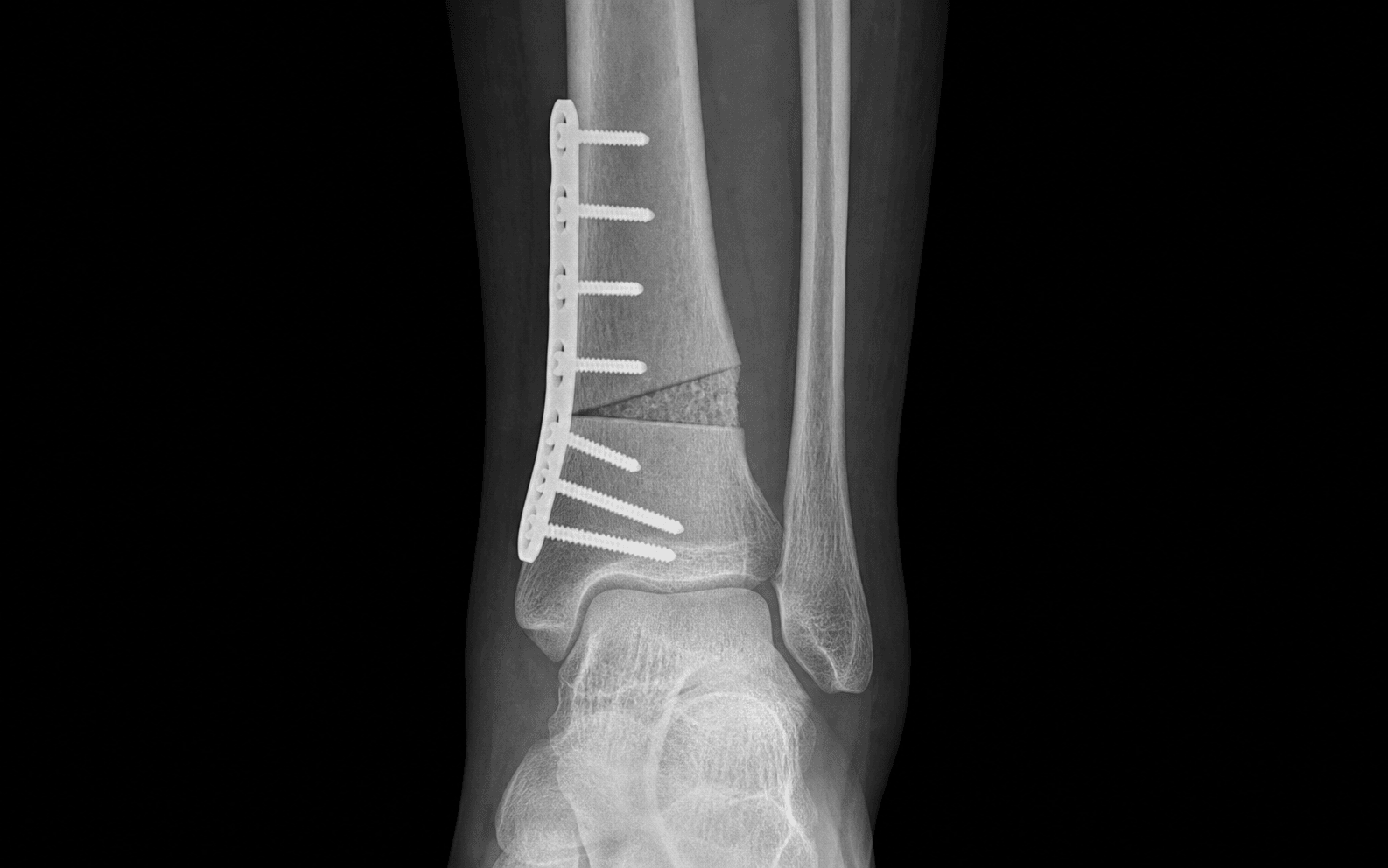 Supramalleolar osteotomy plate fixation