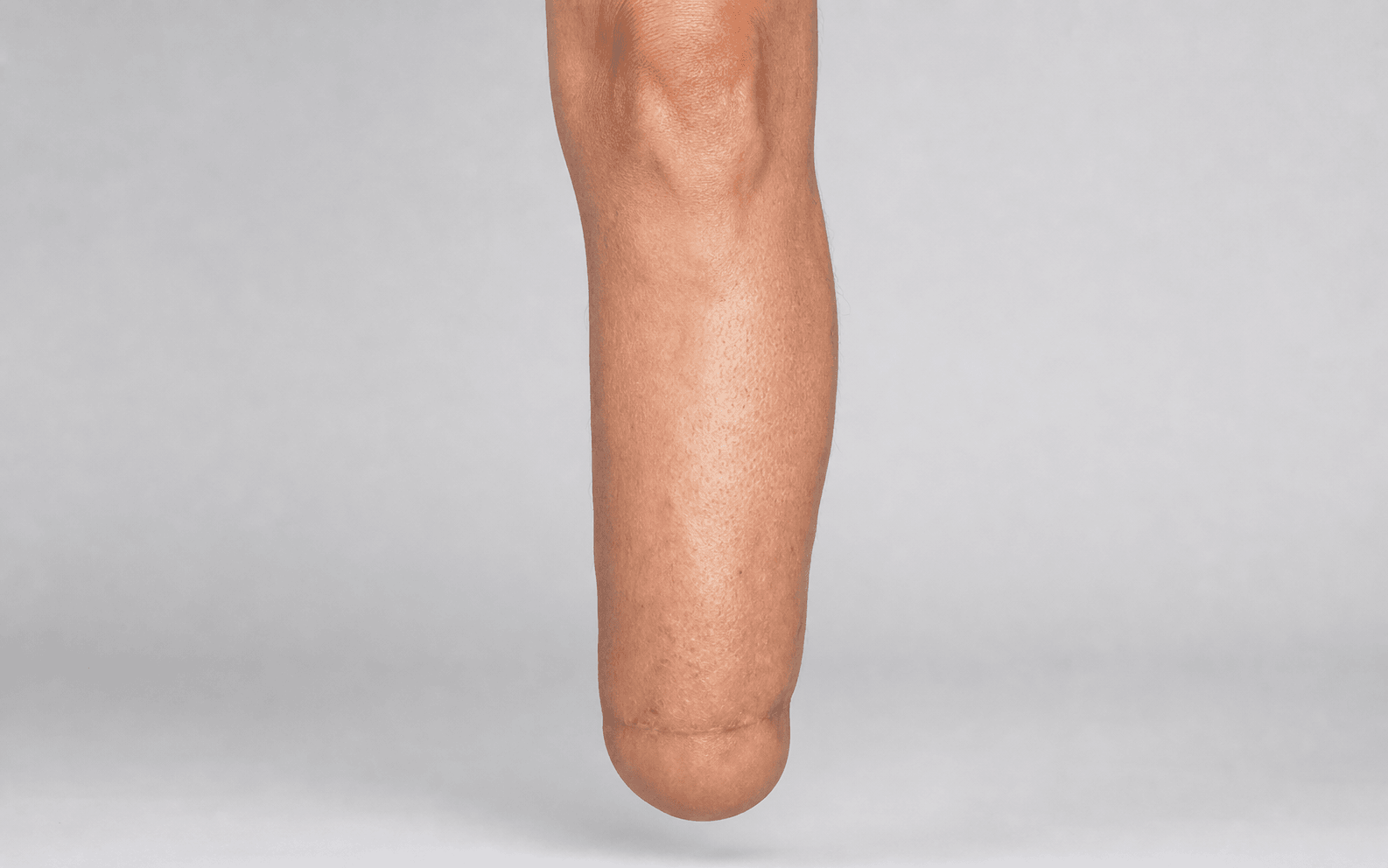 Syme through-ankle amputation stump