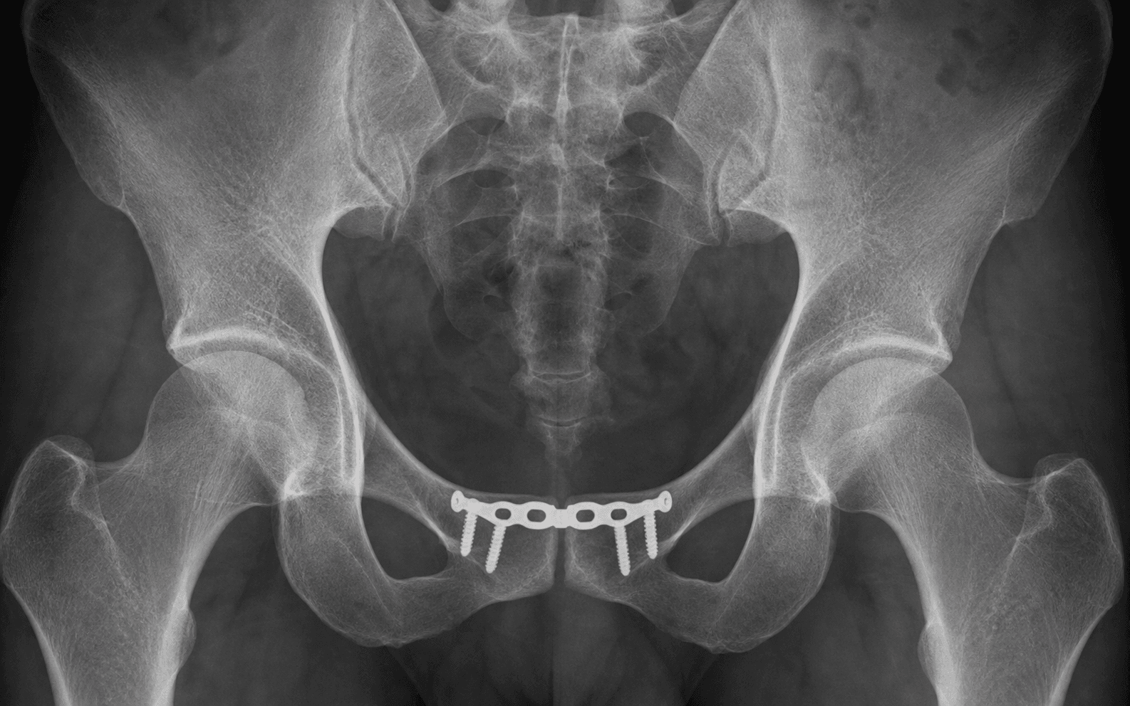 Symphysis pubis plating
