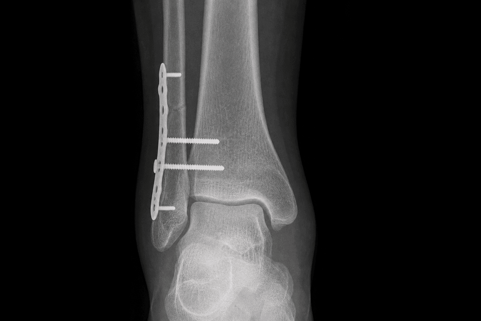 Syndesmotic fixation with fibular plate and screws
