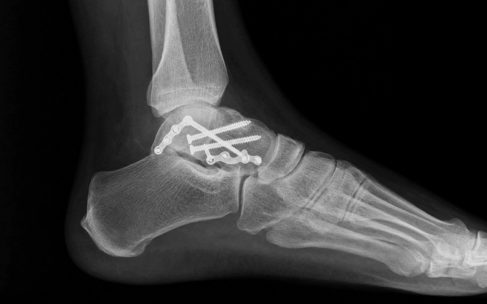 Talus fracture ORIF