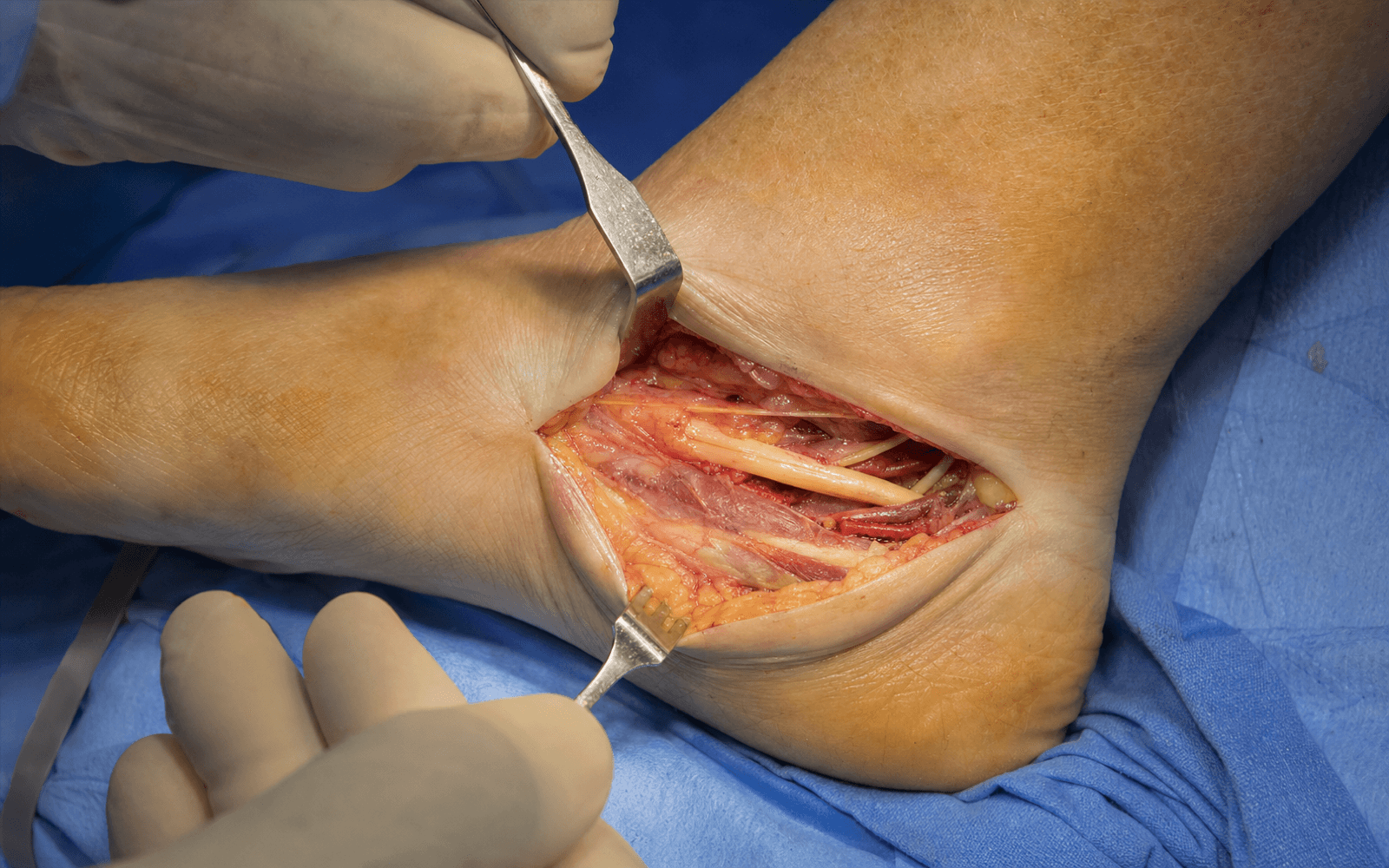 Tarsal tunnel release