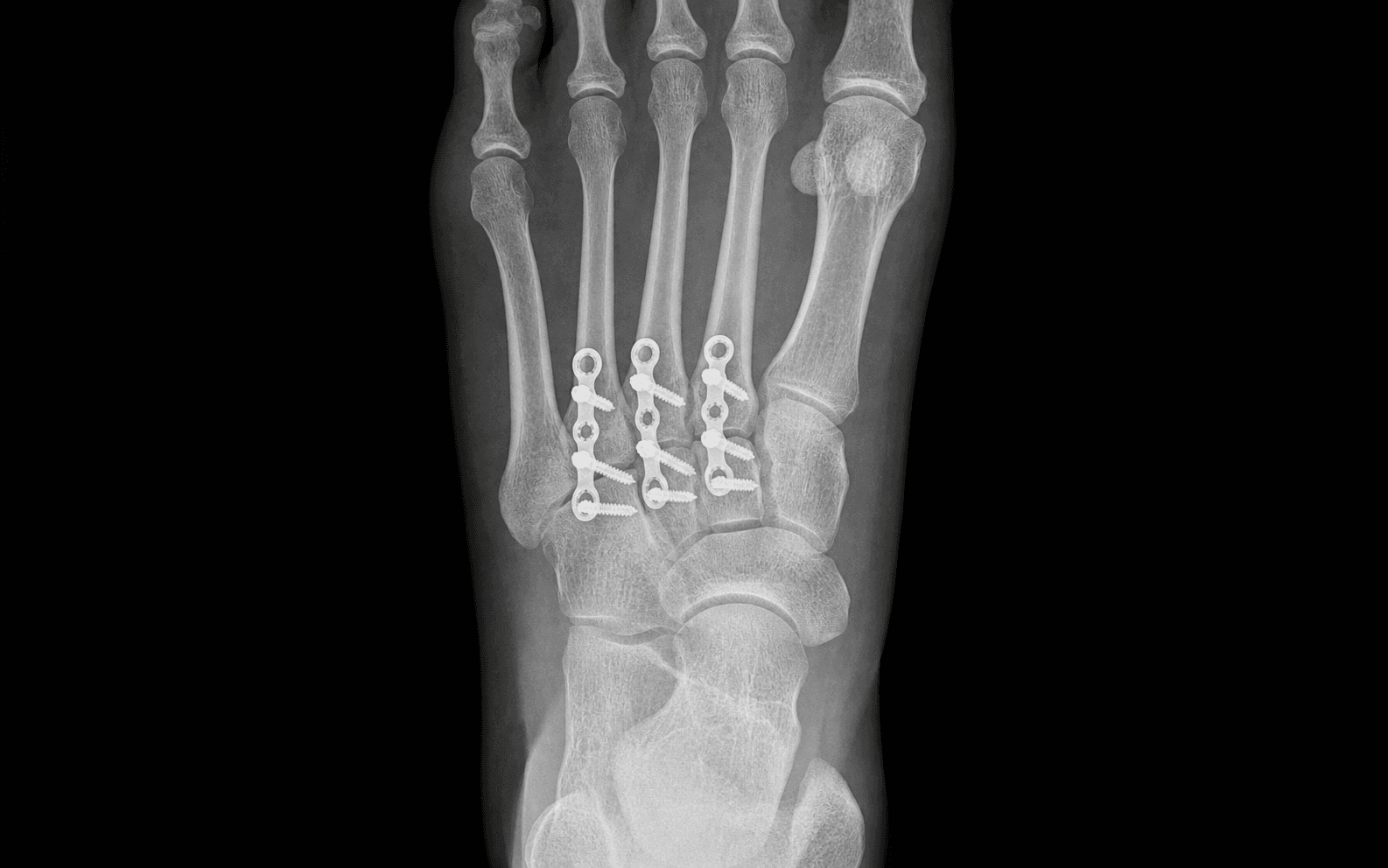 TMT arthrodesis