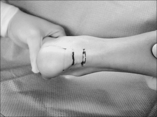 Black and white posterior heel showing incision and sutures after Achilles tendon Z-plasty lengthening