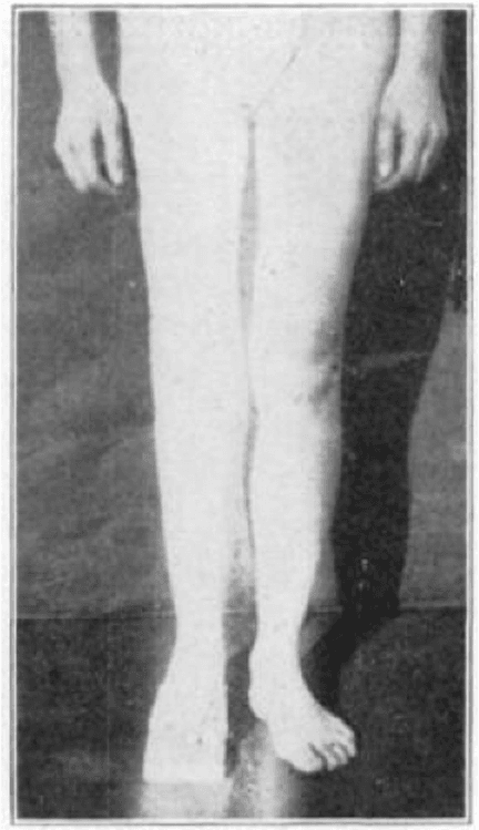 Frontal clinical photo of patient's lower limbs showing bilateral leg alignment