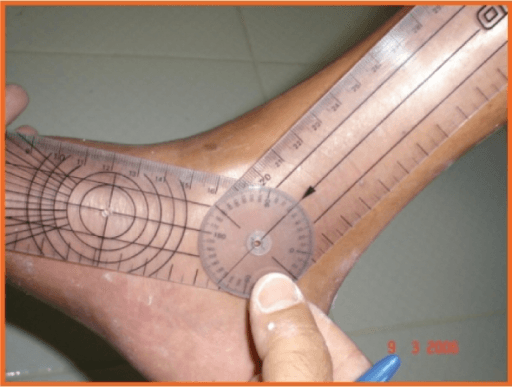 Goniometer measuring ankle dorsiflexion angle on a foot showing limited range of motion