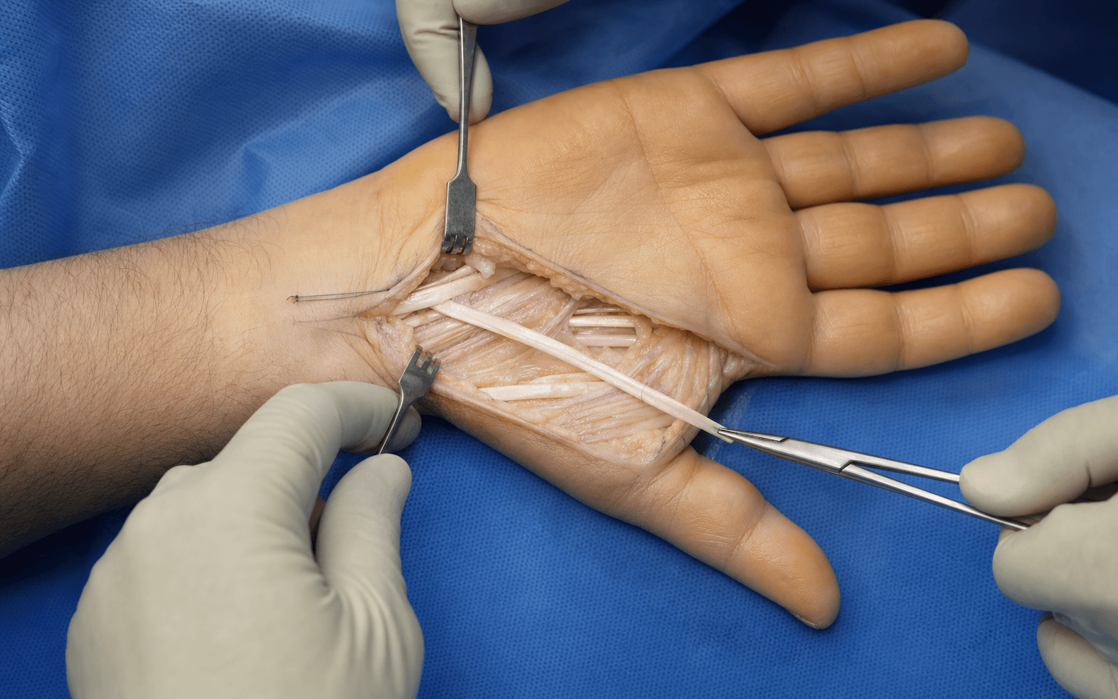Intra-operative tendon transfer in the hand