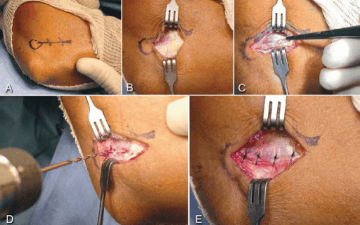 Five-panel series showing open lateral epicondyle release technique steps A through E