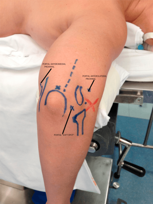 Arthroscopic portal markings on lateral elbow showing proximal anterolateral and midlateral portals