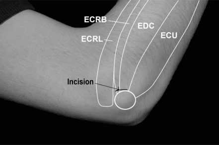 Black-and-white surgical anatomy diagram of lateral elbow showing ECRB, ECRL, EDC and ECU muscles with incision circle