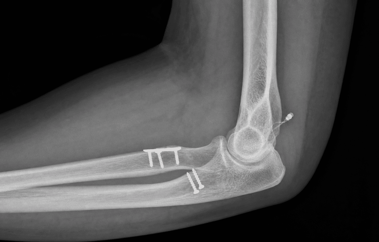 Terrible triad fixation
