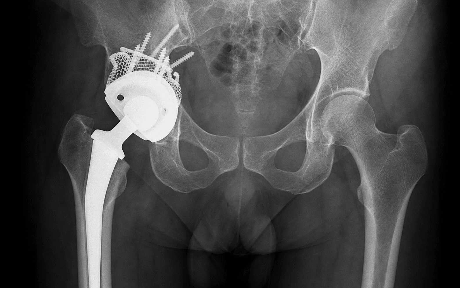 Jumbo cup acetabular revision