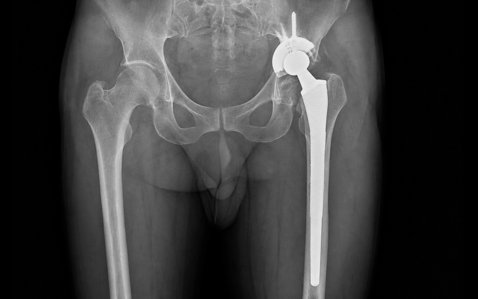 Femoral revision with an extensively porous-coated stem