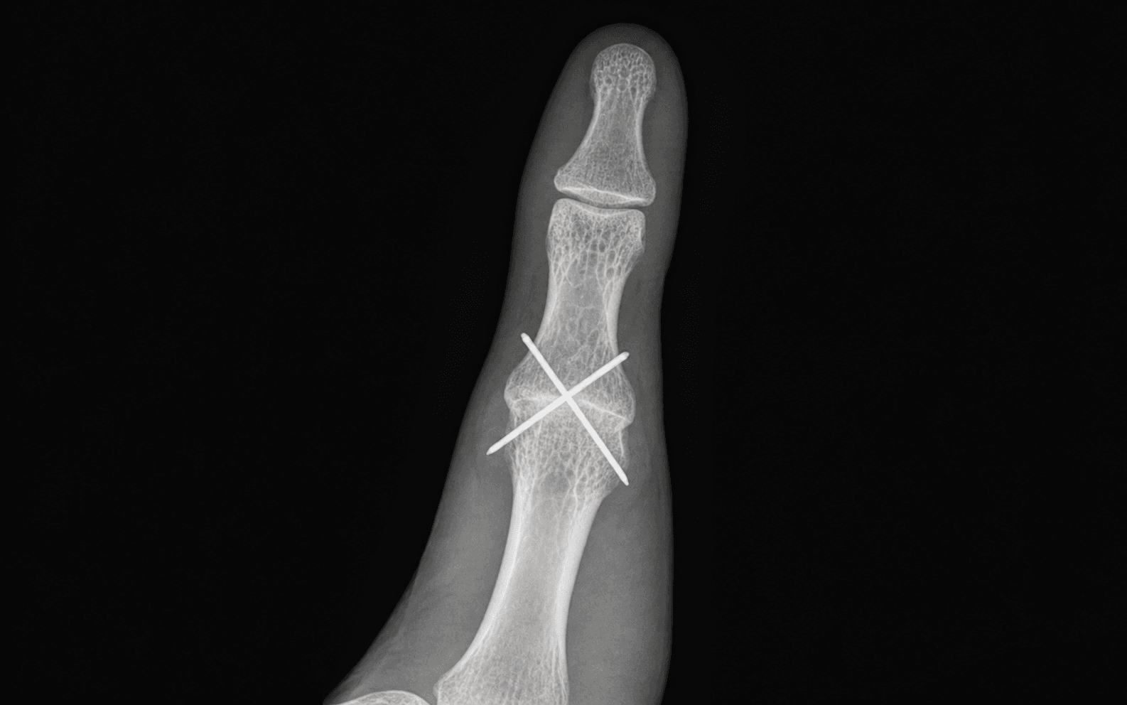 Thumb MCP arthrodesis crossed wires