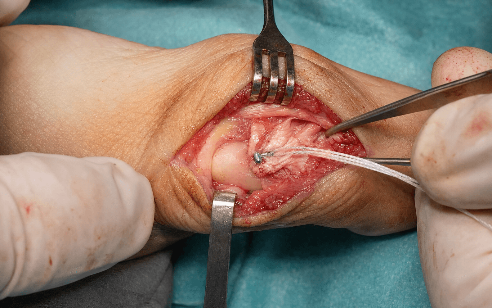 Intra-operative repair of the thumb ulnar collateral ligament