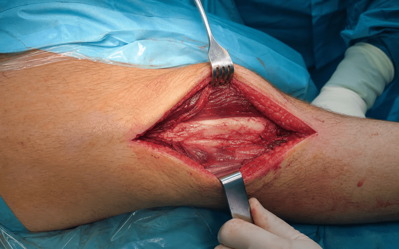 Posterolateral tibia approach